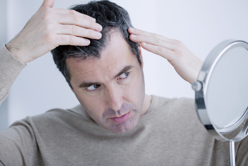 Diagnosi della perdita di capelli nell’uomo
